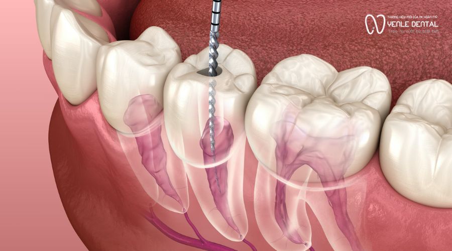 khi nào cần chữa tuỷ răng